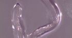 U.S. woman becomes 1st person to have eye worms previously seen only in cattle