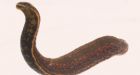 Leech sends man into anaphylactic shock