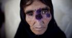 Disfiguring bug caused by ISIS dumping rotting bodies in Syria spreading across the Middle East